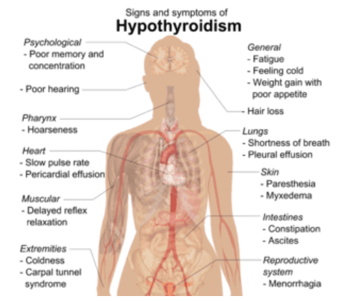 Signs Symptoms of Hypothyroidism diagram