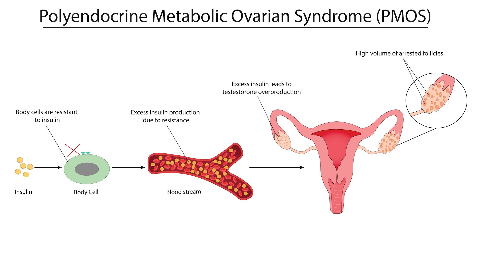 Featured image for “PMOS Is the New Name for PCOS: What This Change Means”